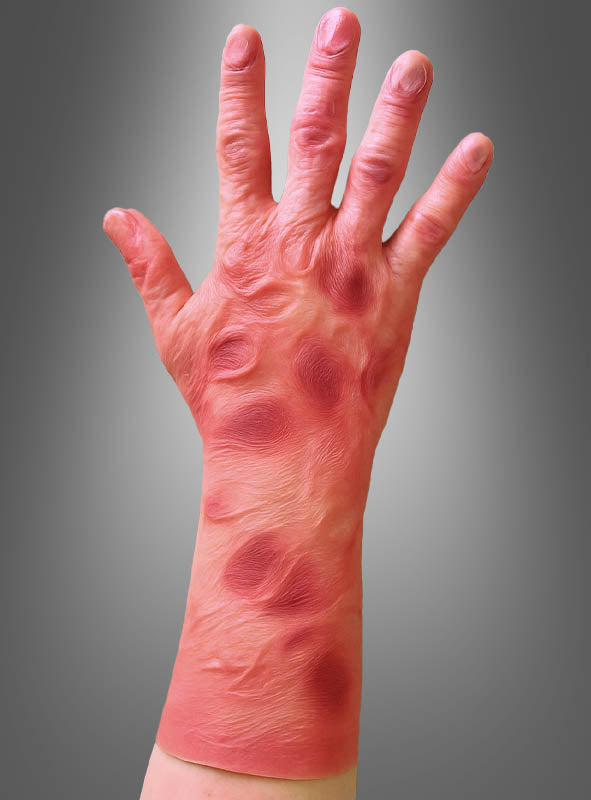 Eine Hand und ein Unterarm mit roten, geschwollenen, kreisförmigen Läsionen und entzündeter Haut – die an das Aussehen von „Ein verbrannter Hauthandschuh Freddy“ erinnern – vor einem grauen Hintergrund mit Farbverlauf.